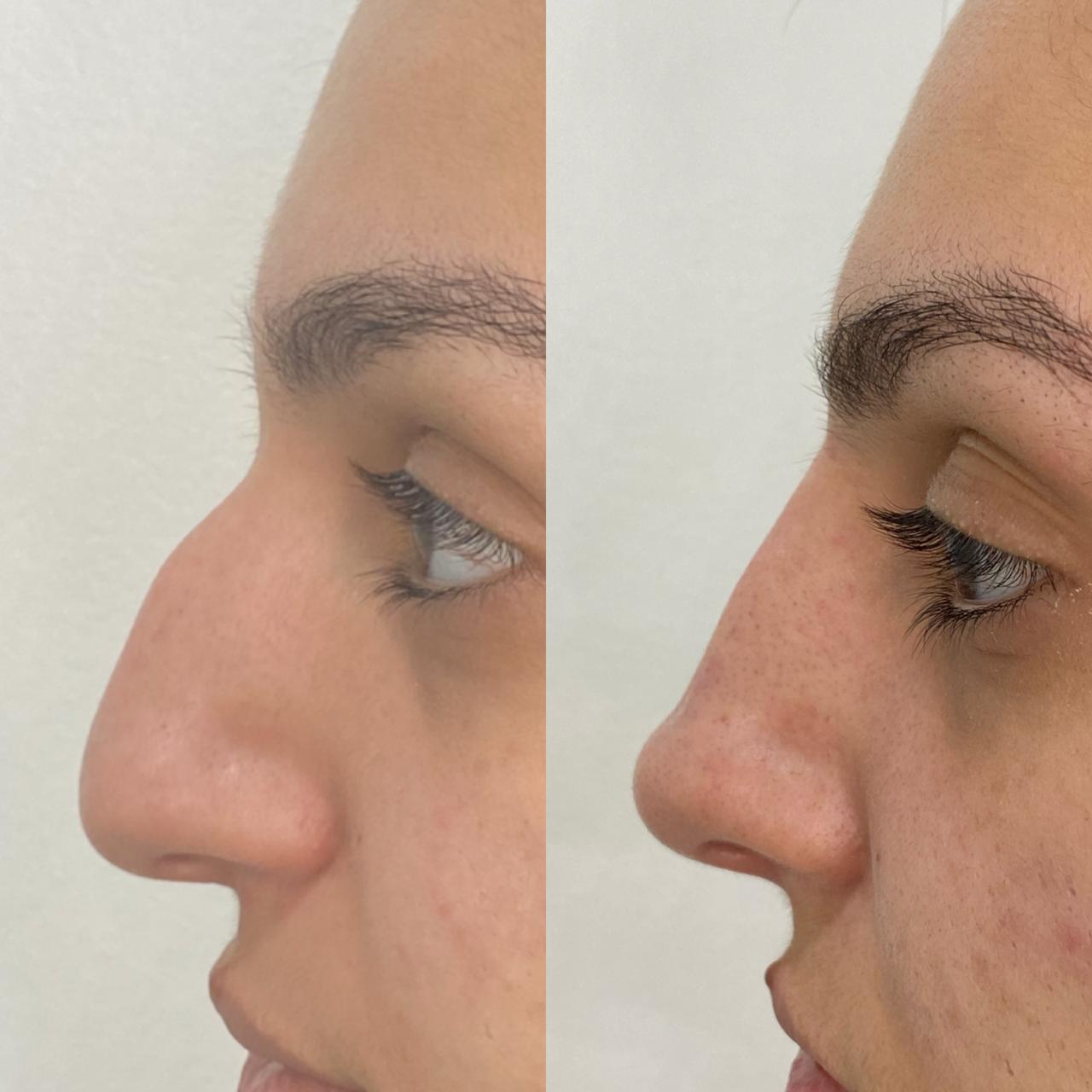 Antes e depois: Rinomodelação - Dra. Roberta Ferraz