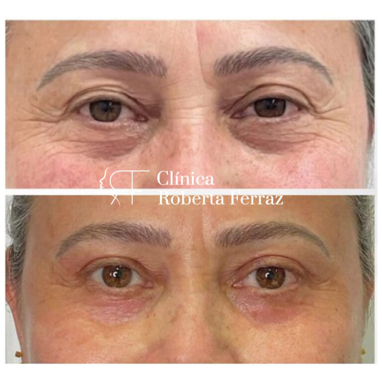 Blefaroplastia sem cortes e sem cirurgia - Rejuvenesça o seu olhar!